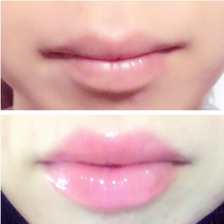 Kaolish lip before after